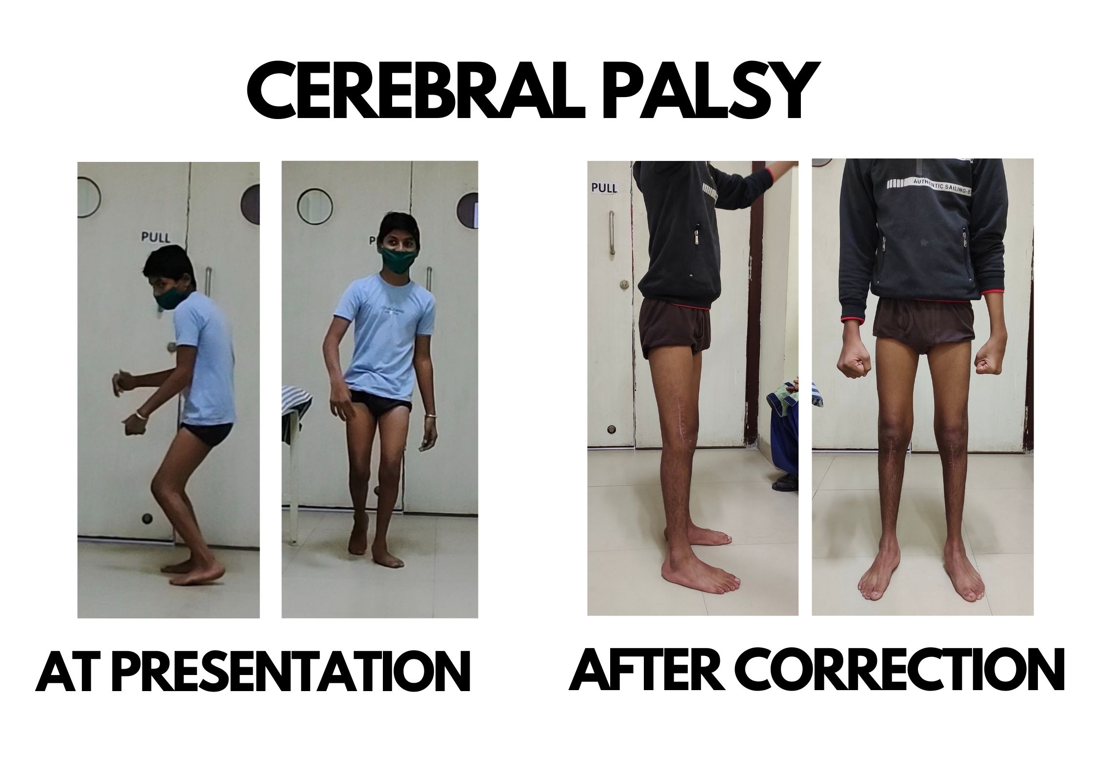 Cerebral palsy
